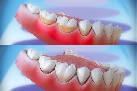 Dental Scaling & Cleaning