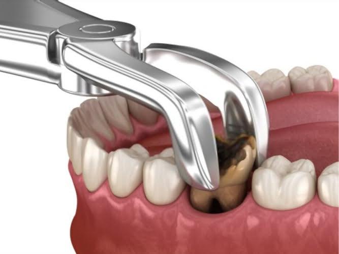 Tooth Extraction